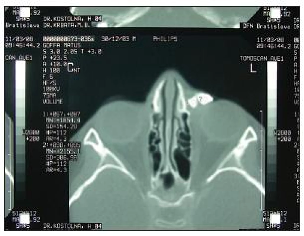 CT po 4 rokoch (2008) s nálezom dentálnych elementov