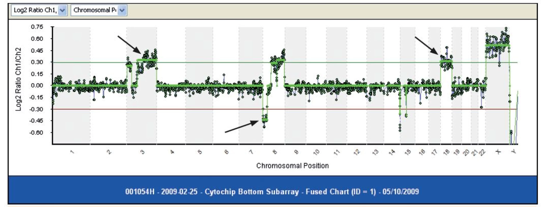Molekulárny karyotyping pomocou metódy array CGH. Metódou môžeme určiť či už (1) zisky, ako na chromozóme 3, alebo (2) delécie, ako na chromozóme č. 8, ako aj (3) zisk - trizómiu celého chromozómu (Odd. lekárskej genetiky, NOÚ, Bratislava)