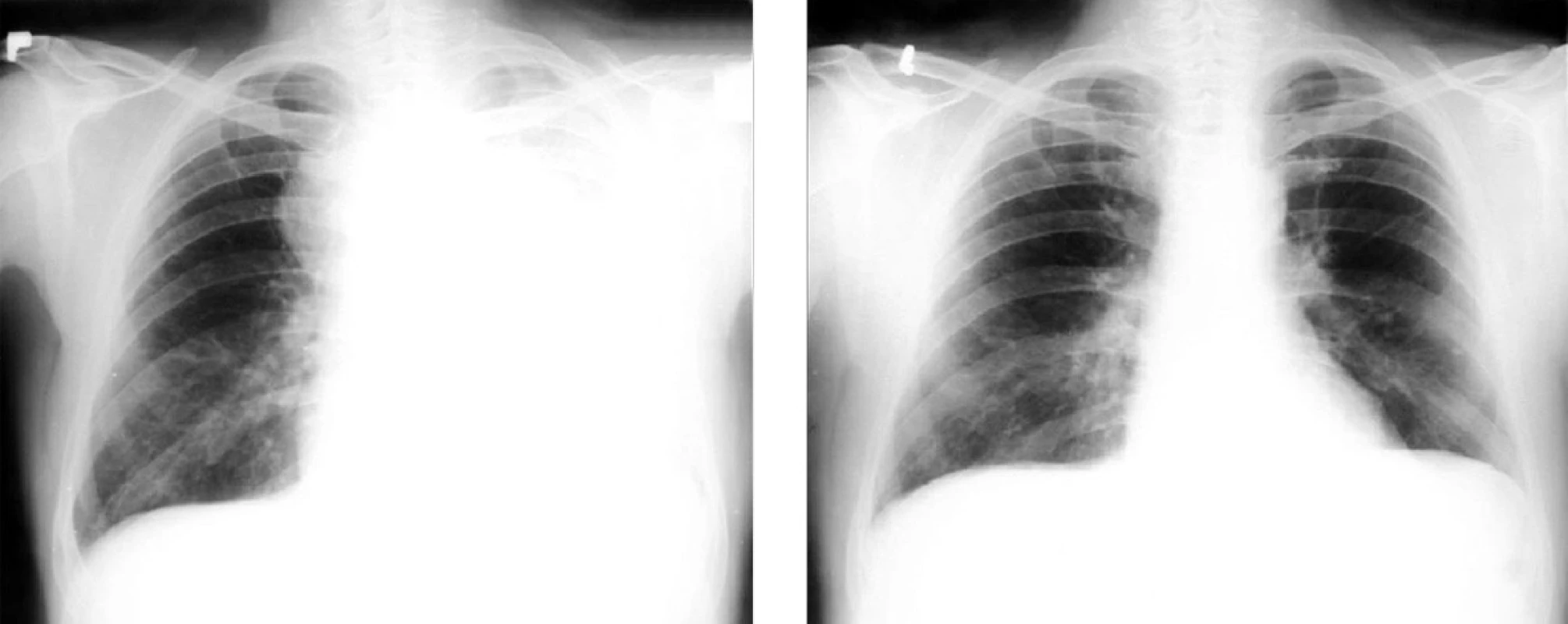 Malobuněčný karcinom levé plíce před léčbou a po léčbě kombinovanou chemoterapií a radioterapií