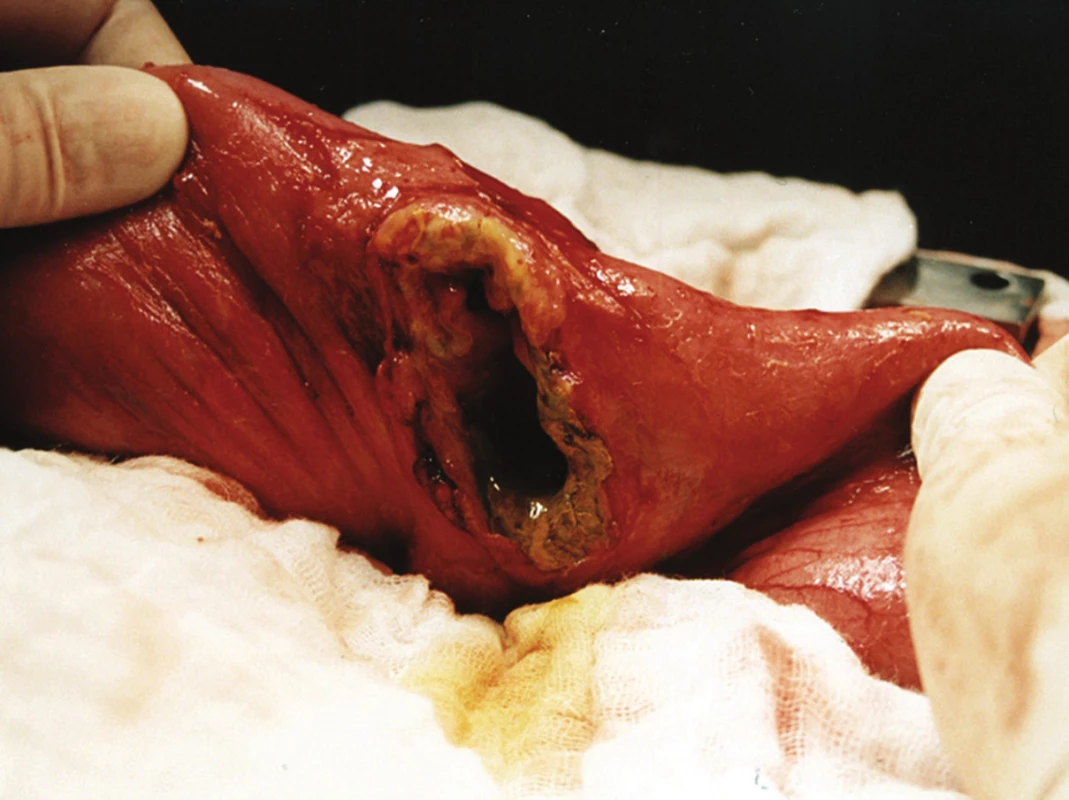 Perforovaný T-lymfom jejuna
Fig. 4: Perforated T-lymphoma of the jejunum
