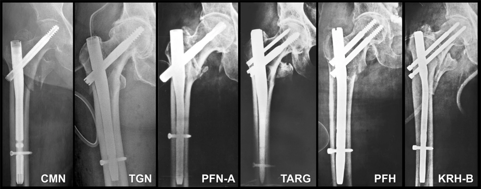 Různé typy PFN: a – CMN hřeb Zimmer; b – trochanterický Gamma hřeb; c –- PFN-A hřeb Synthes; d – Targon hřeb B-Braun; e – PFN Medin; f – KRH Beznoska.
Fig. 7: Various PFN types: a – Zimmer CMN nail; b – trochanteric Gamma nail; c - Synthes PFN-A nail; d – BBraun Targon nail; e – PFN Medin; f – KRH Beznoska.