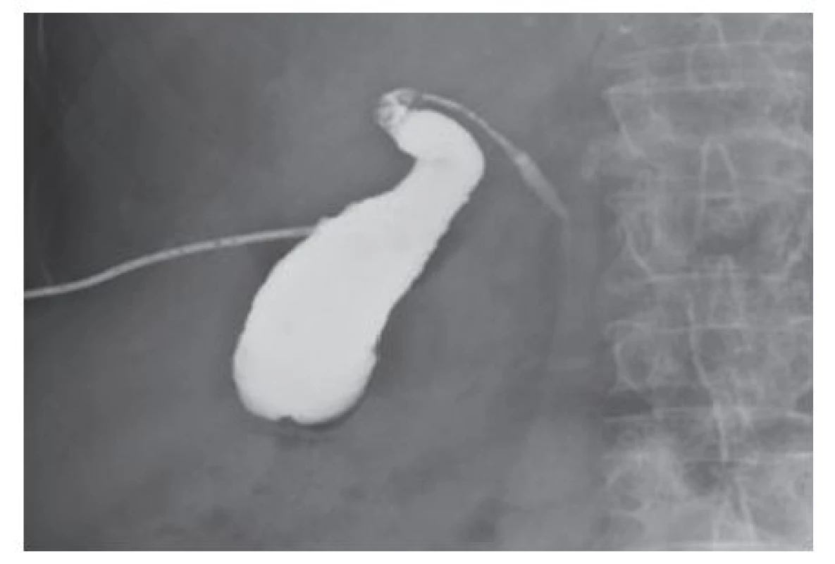 Cholecysto-cholangiografie drénem
Fig. 2: Cholecysto-cholangiography through a drain