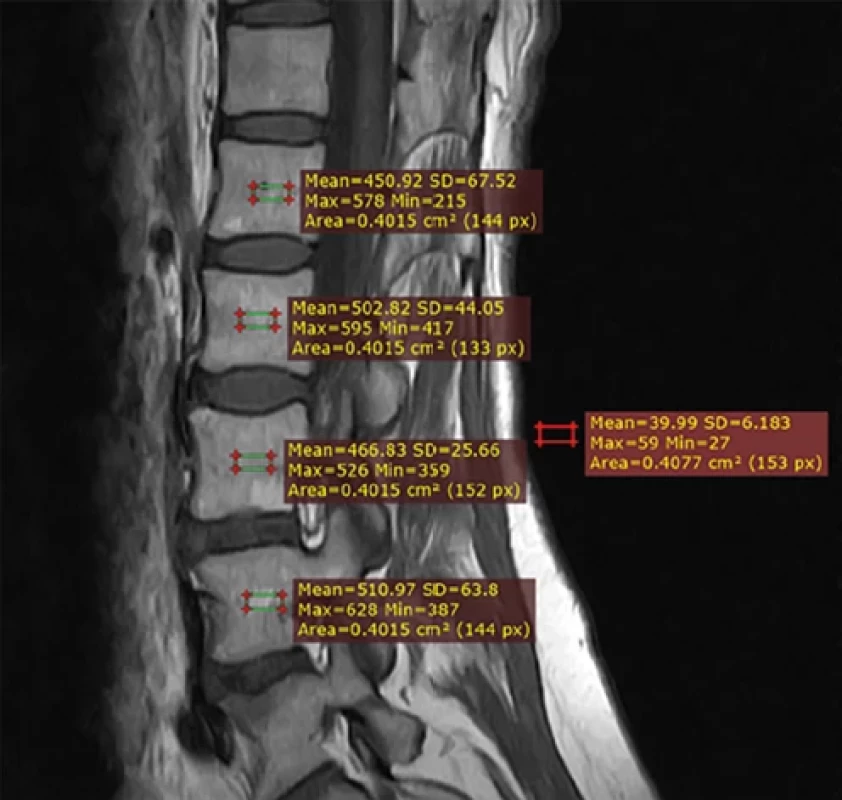 ROI at T1W1 from 1.2T magnetic resonance imaging - female, age 53 years: SNR = 63.363; M-score = 2.9 (own processing)