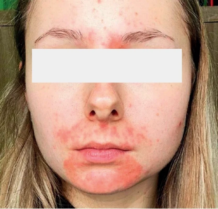 Periorální dermatitida, děvče 15 let