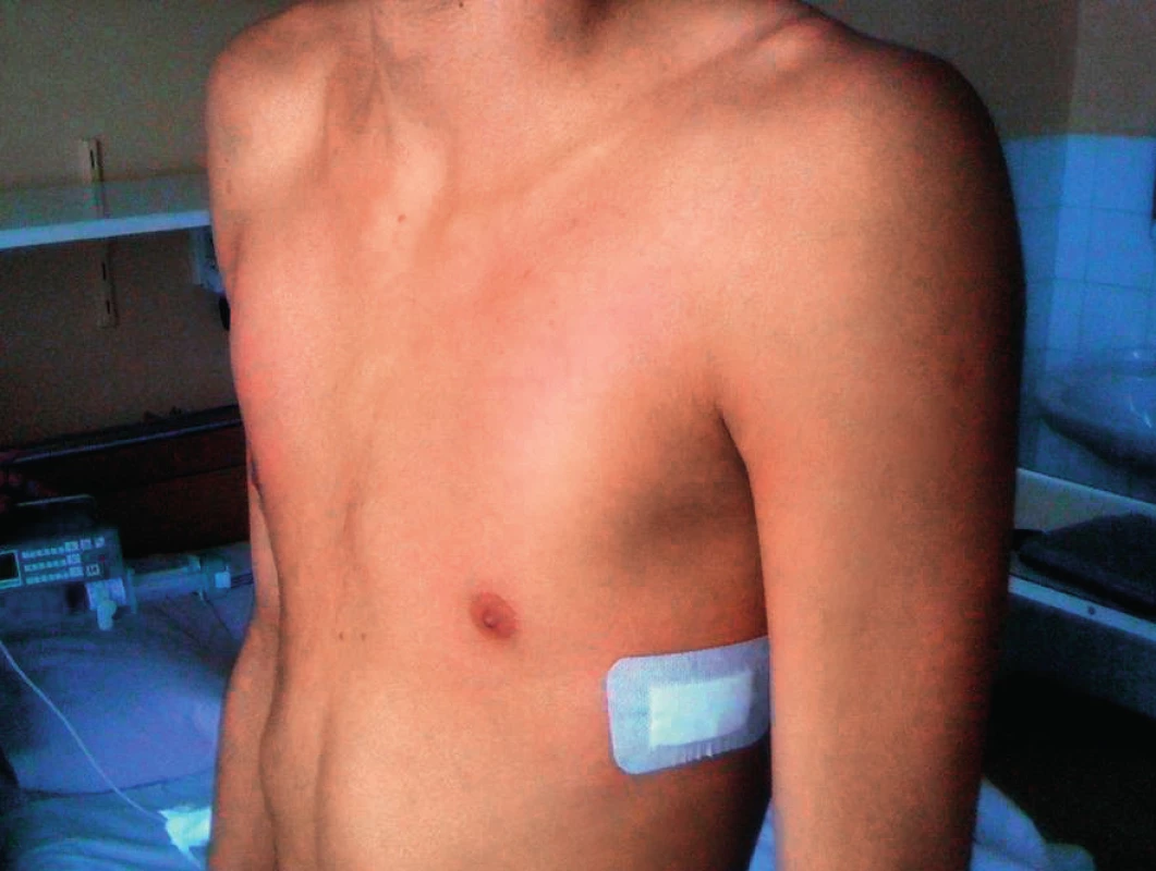 Příznivý pooperační výsledek u chlapce z obr. 5.
Fig. 6. Favorable postoperative result in a boy in Fig. 5.
