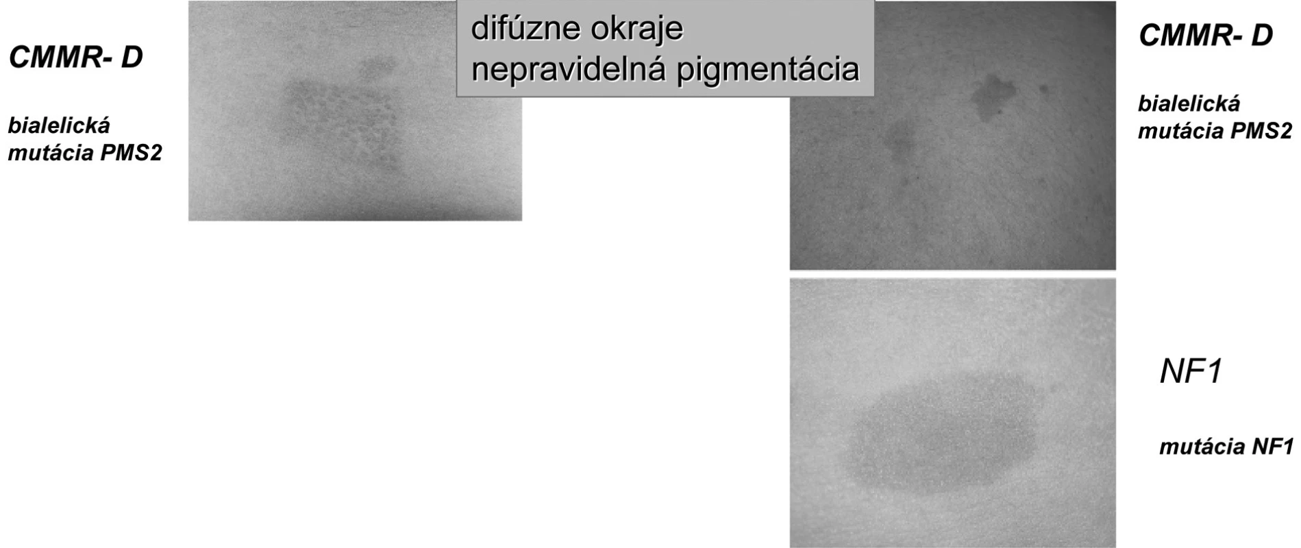 Charakter CAL pigmentácií pri syndróme deficitu konštitučného „Mismeč reparačného systému“
(CMMR-D) [18].