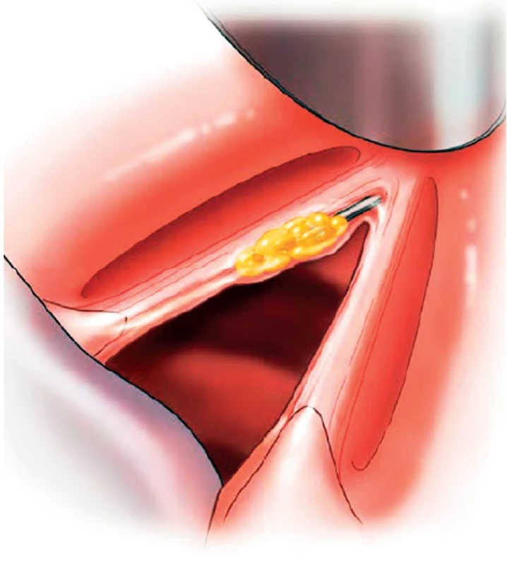 Schéma „Gray minithyrotomy“ (podle Rosen C. A.: Operative techniques in laryngology, Springer, 2009).
