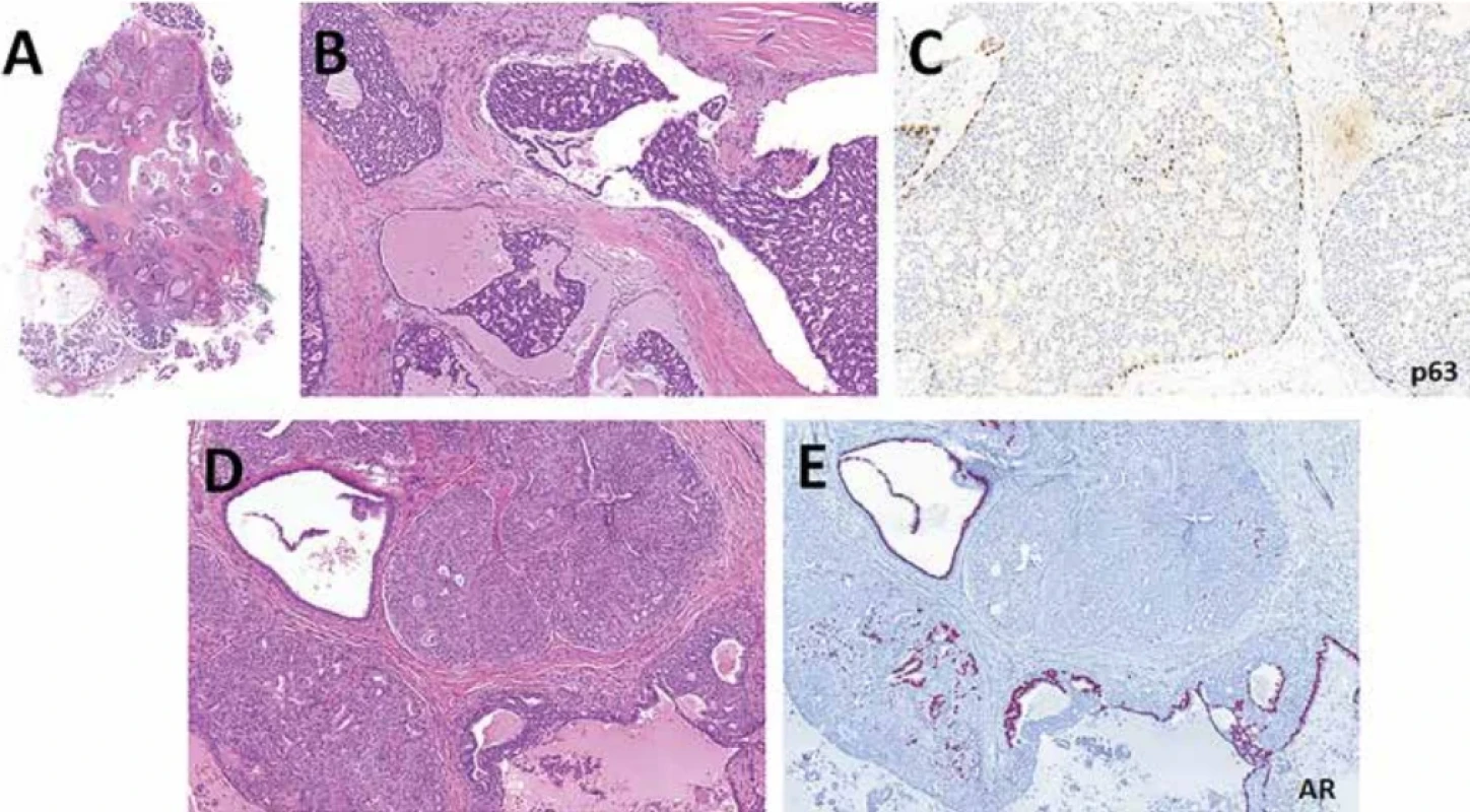  Intraduktální karcinom, „intercalated duct“ typu (A-C) a hybridního typu (D-E). V imunohistochemickém průkazu p63 proteinu je patrná intaktní abluminální vrstva buněk (C). V hybridnímu typu se střídají ložiska nádorových buněk s imunoprofilem buněk vmezeřených vývodů/„intercalated duct“, a buněk apokrinného fenotypu, zde pozitivních na androgenní receptory AR (E).