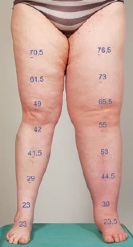 Pacient (No. 6) with more severe lymphedema of left lower limb.