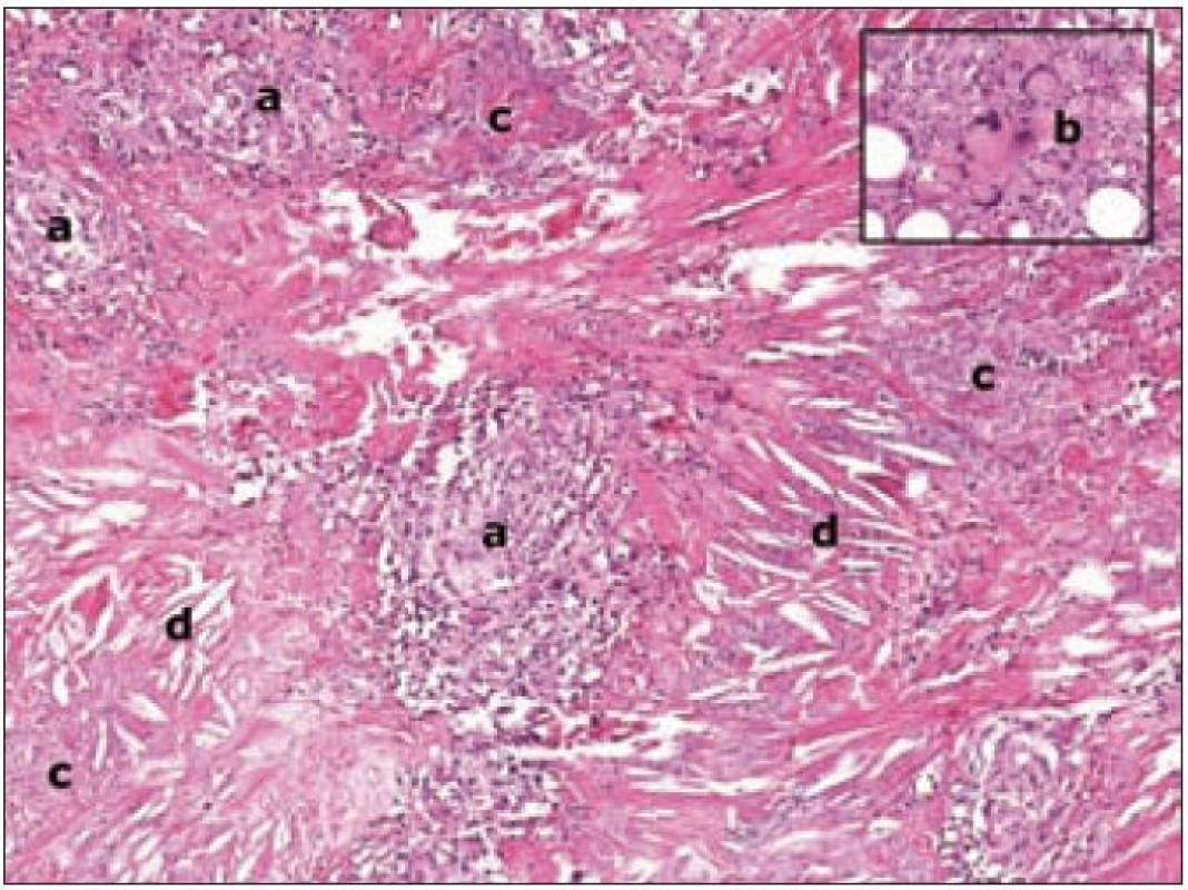 Histologický nález z ložiska nekrobiotického xantogranulomu.

V celém rozsahu koria je hustý histiocytární infiltrát (a), který zasahuje až do tukové tkáně ve spodině excize. Histiocyty mají širokou eozinofilní cytoplazmu, někde mírně zrnitou. Jádra jsou velká, světlá, chromatin je jemný, v některých buňkách jsou nevelká jadérka. Jednotlivě i ve skupinách se nacházejí obrovské histiocytární elementy s širokou cytoplazmou a vícečetnými jádry (b). Ojediněle jsou přítomny pravidelné mitózy. V infiltrátu dochází k rozsáhlé nekrotizaci (c). Přítomny jsou drobné nekrózy s jaderným popraškem i rozsáhlé oblasti nekrózy, tvořené eozinofilní hmotou s hojnými štěrbinami po cholesterolových krystalech (d).