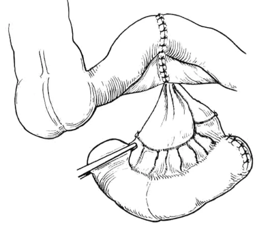 Ureteroileostomie podle Brickera – exkluze kličky ilea z pasáže
Převzato z: Droller JM. Surgical management of urologic disease an anatomic approach. St.Loius, Mosby – Yaer Book, Inc. 1992:1149.
Fig. 1 Ureteroileostomy according to Bricker – ileal loop, excluded from the intestinal pasage 
According to: Droller JM. Surgical management of urologic disease: an anatomic approach. St.Loius, Mosby-Year Book, Inc. 1992:1149.