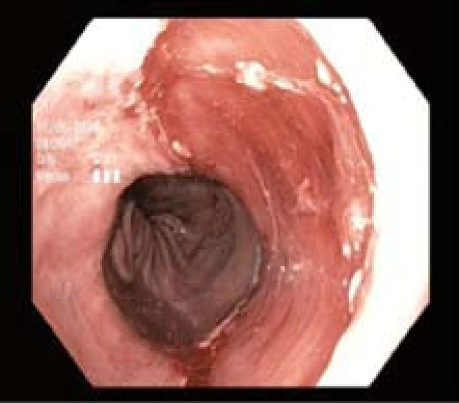 Spodina po endoskopické resekci.
Fig. 4. Resected area after endoscopic resection
