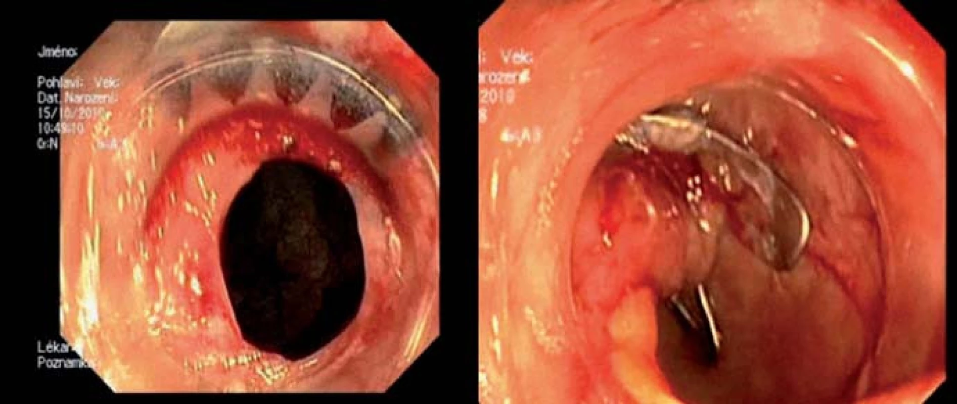 Úspěšný uzávěr perforace sigmoidea OVESCO klipem (první klinické použití OVESCO klipu v ČR v roce 2011 [6].
Fig. 1. Successful closure of sigmoid colon perforation with an OVESCO clip (the first clinical use of OVESCO clip in the Czech Republic in 2011 [6].