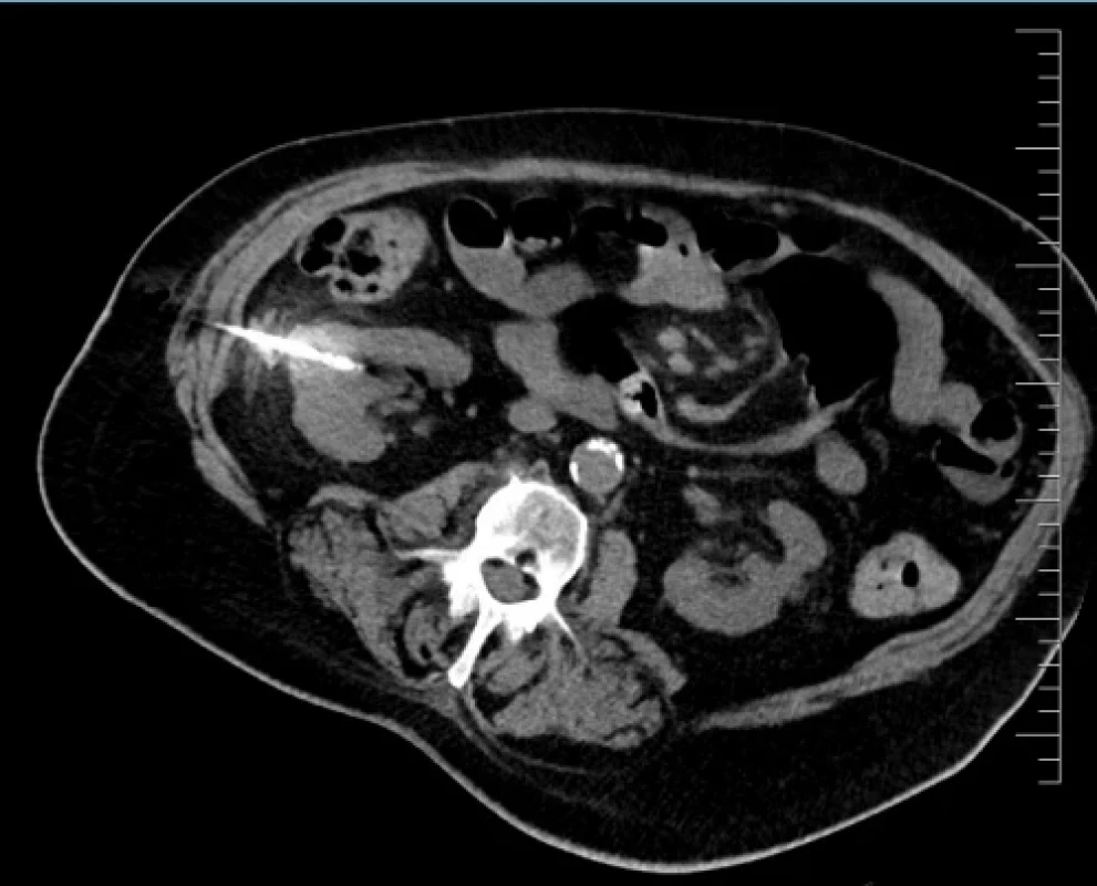 Perioperační CT snímek během MWA. Fig. 1. Perioperative CT scan during microwave ablation.