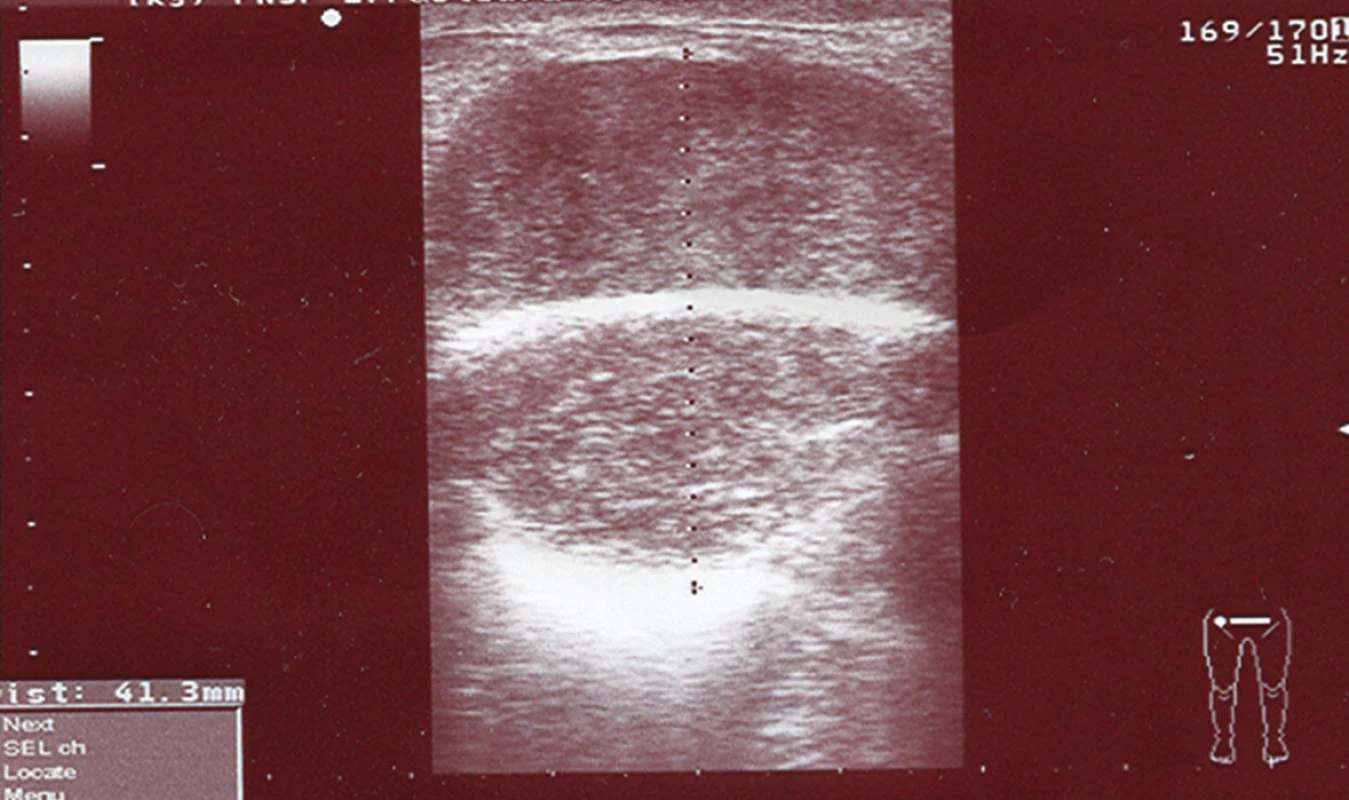 USG znázornenie metastázy adenokarcinómu prerastajúca prolénovú sieťku
Fig. 3. Ultrasonography of metastasis of adenocarcina overgrowing the Prolene net