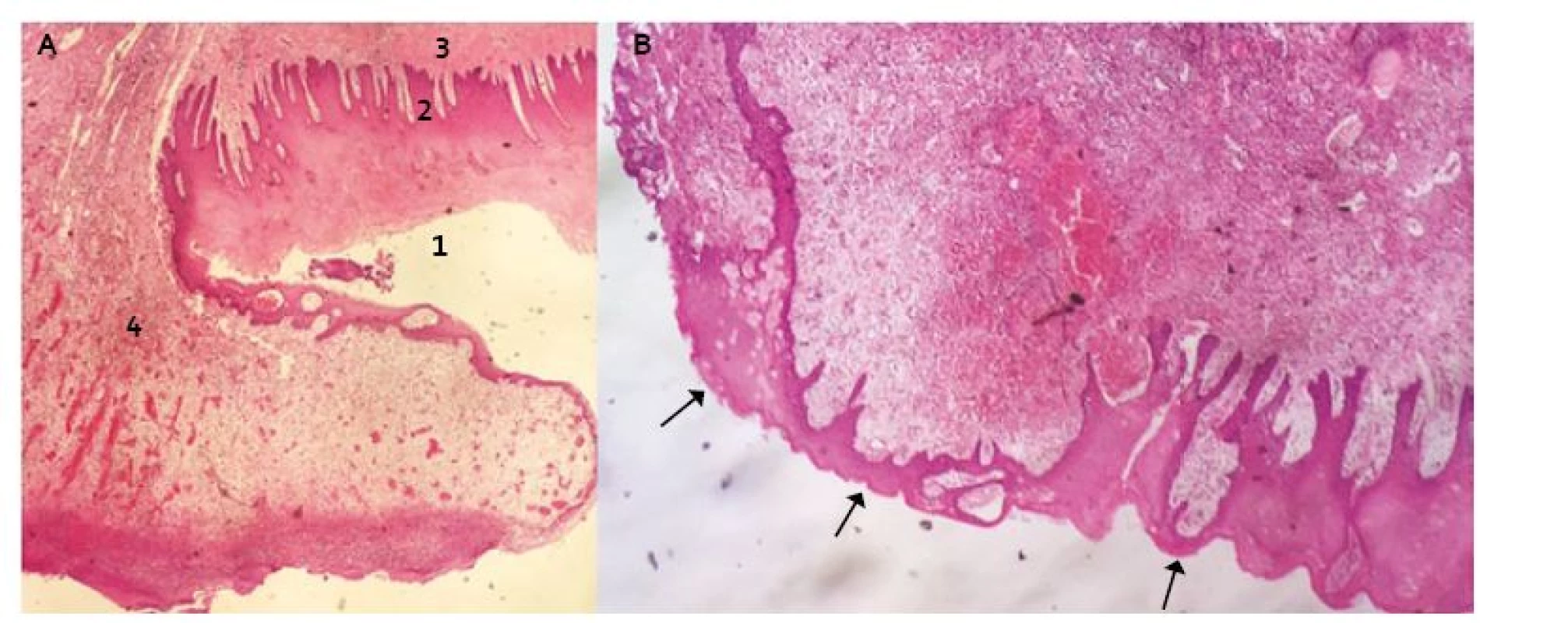 Transverzální řez distálního jícnu v místě resekční plochy s protekcí Xe-Dermou<sup>®</sup> (Hematoxilin-Eosin): A. 1. vrstevnatý dlaždicový epitel nerohovějící – povrchová vrstva s jádry, 2. epitel vrstevnatý dlaždicový nerohovějící – vrstva bazální, 3. tunica submucosa, 4. fibrinózně hnisavý exsudát s granulační tkání (součást hojení). B. Šipky ukazují re-epitelizaci přes submukózu.
Fig. 2. Transversal incision of distal oesophagus at the resection site with Xe-Derma cover<sup>®</sup> (Haematoxylin-Eosin): A. 1. non-keratinized stratifi ed squamous epithelium – the superficial layer, 2. non-keratinized stratified squamous epithelium – the basal layer, 3. tunica submucosa, 4. fi brinous-purulent exudate with granulation tissue (as a healing component). B. The arrows show the re-epithelialization over submucosa.