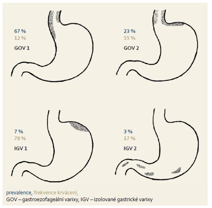 Klasifikace žaludečních varixů dle Sarina et al [74].
Fig. 1. Classification of gastric varices according to Sarin et al. [74].