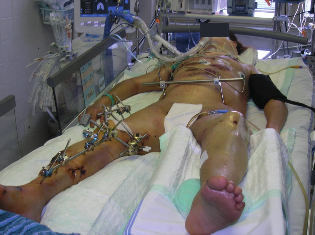 Oboustranná těžká plicní kontuze při sériových zlomeninách žeber si vyžádala provedení DCO metody u polytraumatizovaného pacienta se zlomeninou pánve a pravé dolní končetiny
Fig. 1: Bilateral serious lung contusion with serial rib fractures required the employment of the DCO method in a polytraumatized patient with pelvic fracture and fracture of the right lower limb