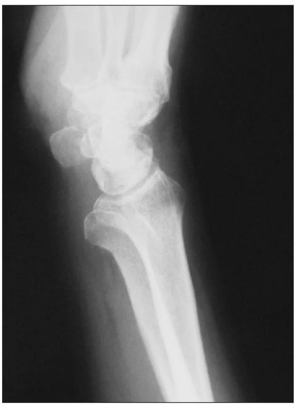 Bočná RTG snímka ľavého zápästia 4 mesiace po úraze, luxácia hlavičky ulny pretrváva
Fig. 3. Lateral radiograph of the left wrist taken 4 months after injury, dislocation of the ulnar head persists