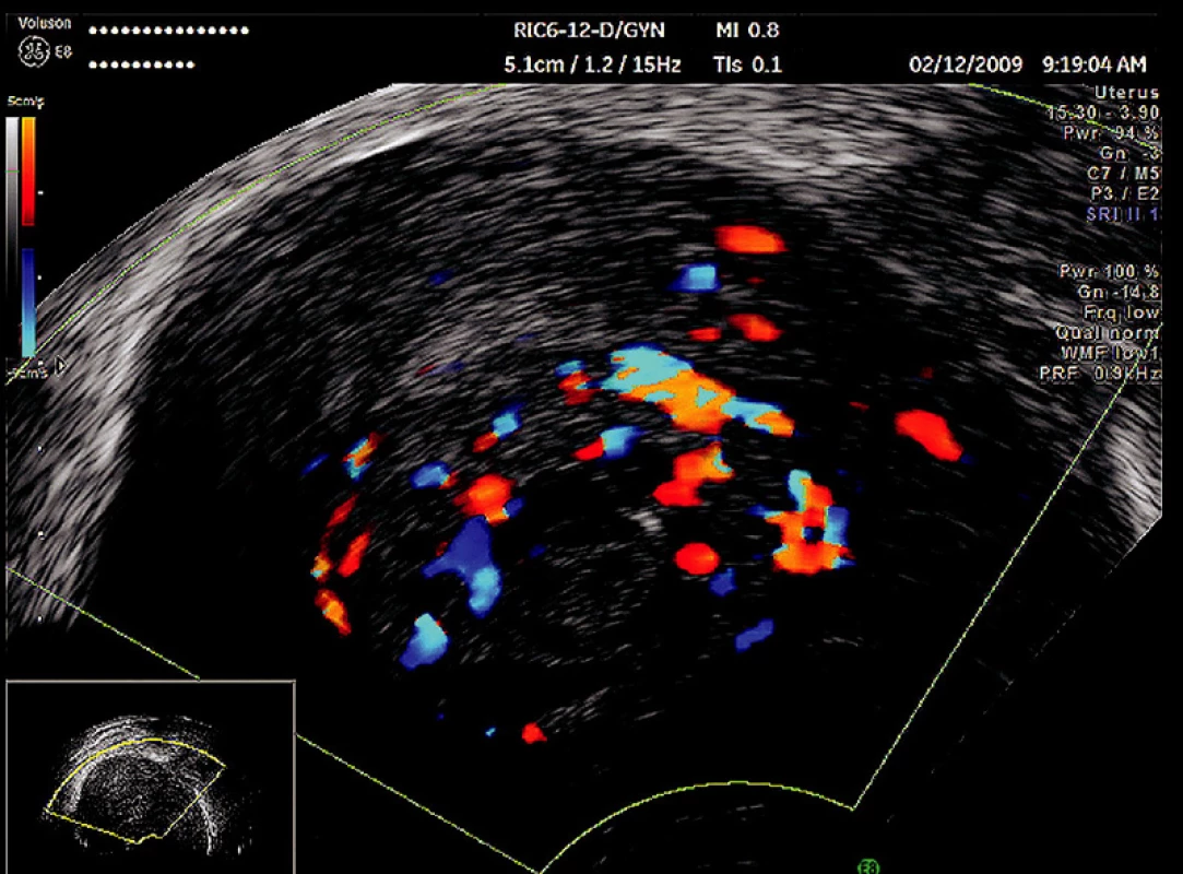 Mola proliferans – invasiva. Invaze do myometria – CFM