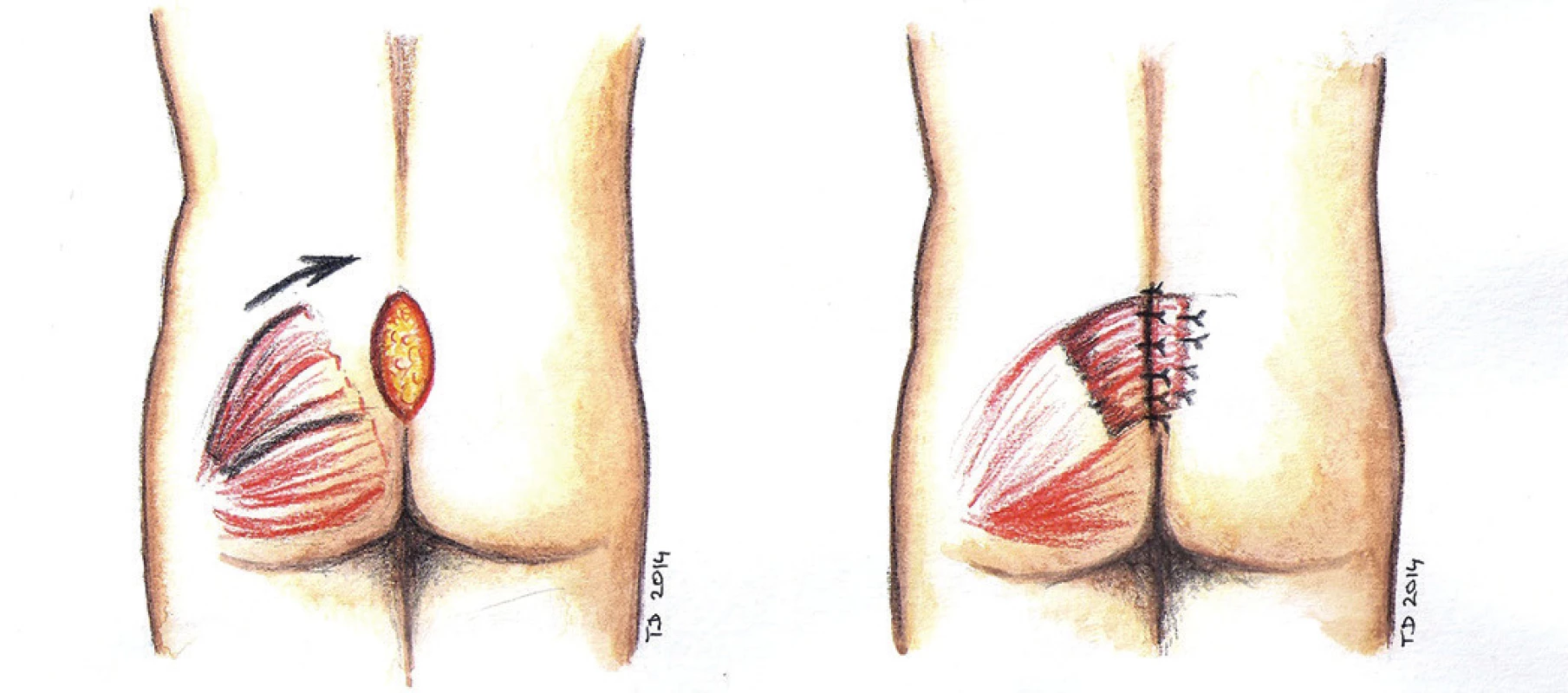 Lalokový posun za použití svalu - schéma
Fig. 7: Muscle flap reconstruction - scheme