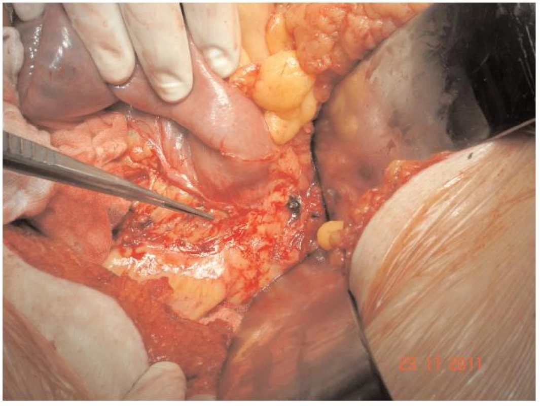 Intimní naléhání duodena na aortu (peroperační nález)
Fig. 3: Adherence of duodenum to the aorta (peroperative fading)