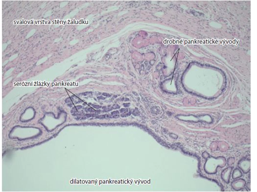 Svalová vrstva žaludeční stěny, pankreatické acini, malé a dilatované
vývody. Barvení hematoxylin-eozinem, zvětšení 10×.<br>
Fig. 3. Musculous layer of gastric wall, pancreatic acini, small dilated ducts.
Haematoxylin and eosin staining, magnification 10×.