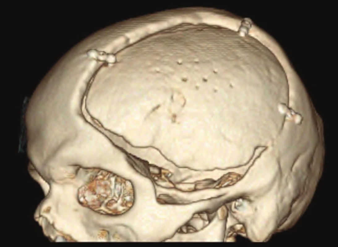3D model lbi − kranioplastika vlastní kostí
Fig. 1: 3D reconstruction of skull − autologous cranioplasty with bone flap