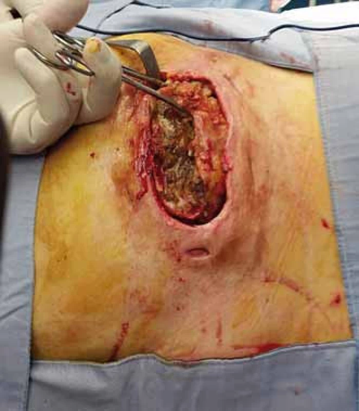 Trochanterický dekubitus s pseudocystou.
Fig. 1. Trochanteric decubitus (pressure ulcer) with pseudocyst.