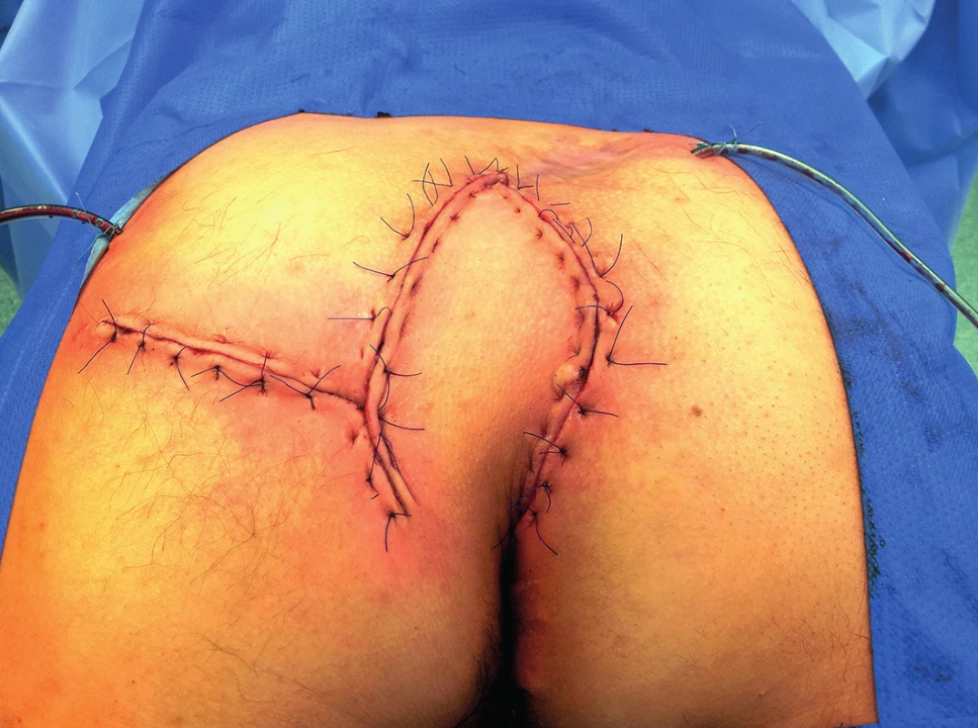 Stav po výkonu
Fig. 5: Finding after Limberg flap procedure