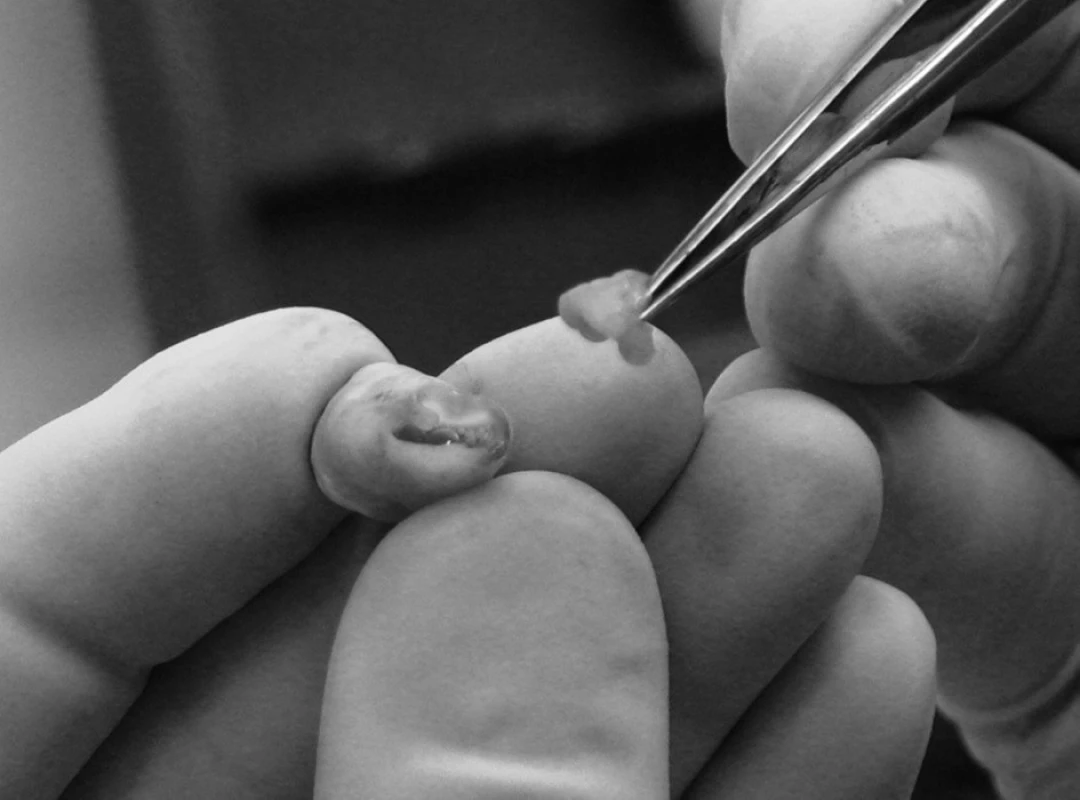 Extrahovaný zub 38 – dřeňová dutina široce komunikuje s okolím