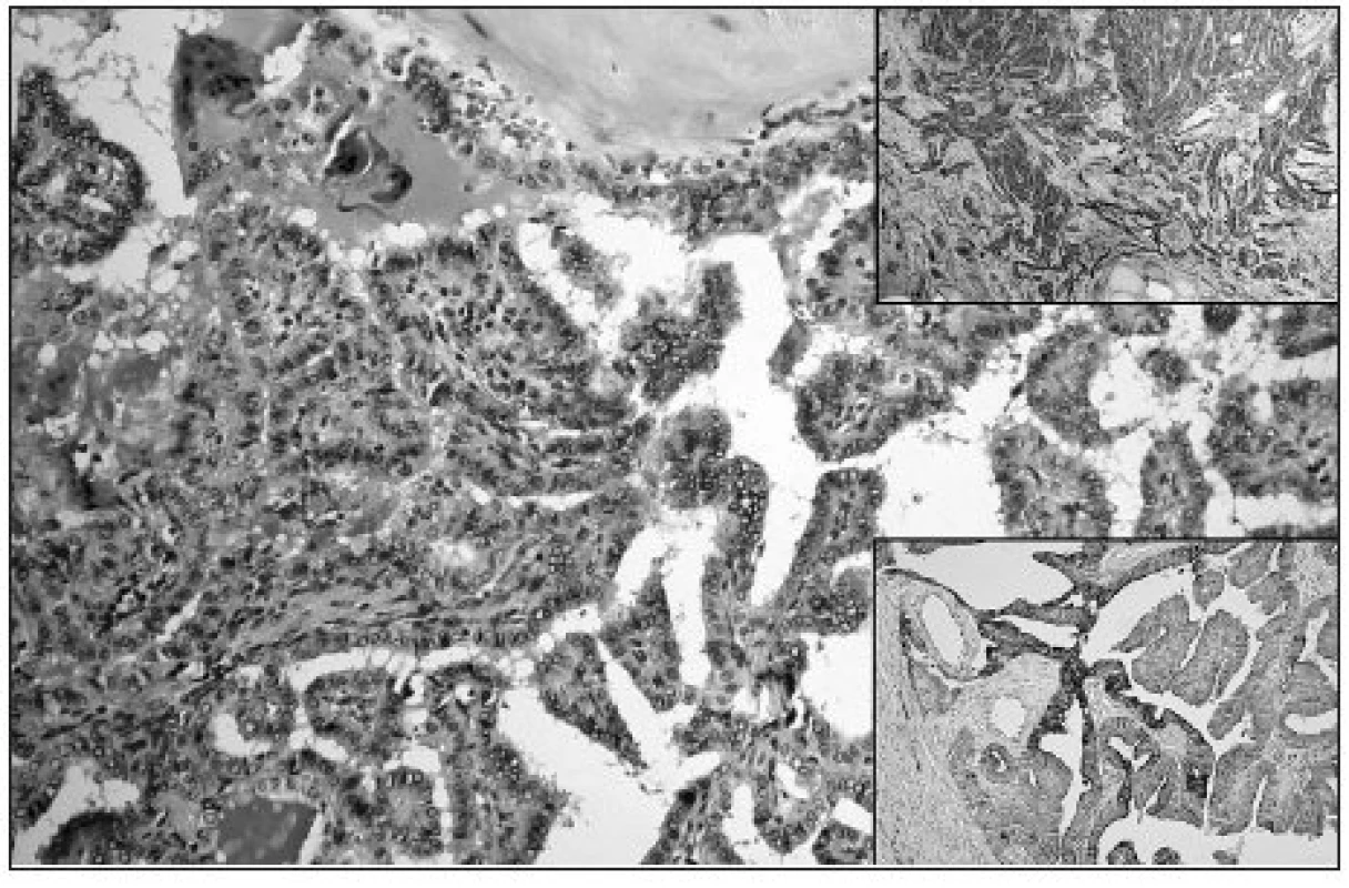 Papillary growth pattern of cPTC; ground glass nuclei of tumor cells are evident (HE, original magnification 200x). Upper right: Diffuse strong Gal3 expression in cPTC (original magnification 100x). Lower right: Diffuse focally strong expression of CK19 in cPTC (original magnification 100x)