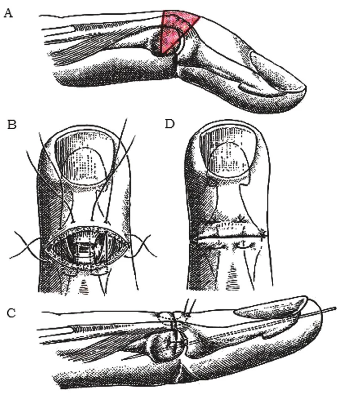 Korekcia chronickej mallet deformity
a) excízia kože a šľachového kalusa,
b) naložené matracové stehy en bloc cez kožu, šľachu a ev. kĺbové puzdro,
c) transfixovaný DIP kĺb Kirschnerovým drôtom v miernej hyperextenzii,
d) zauzlenie stehov [2].
Fig. 7: Correction of chronic mallet deformity
a) excision of skin and tendon callus,
b) placing the matrace sutures en bloc through the skin, tendon and ev. articular capsule,
c) K-wire fixes the DIP joint in slight hyperextension,
d) sutures are tied [2].