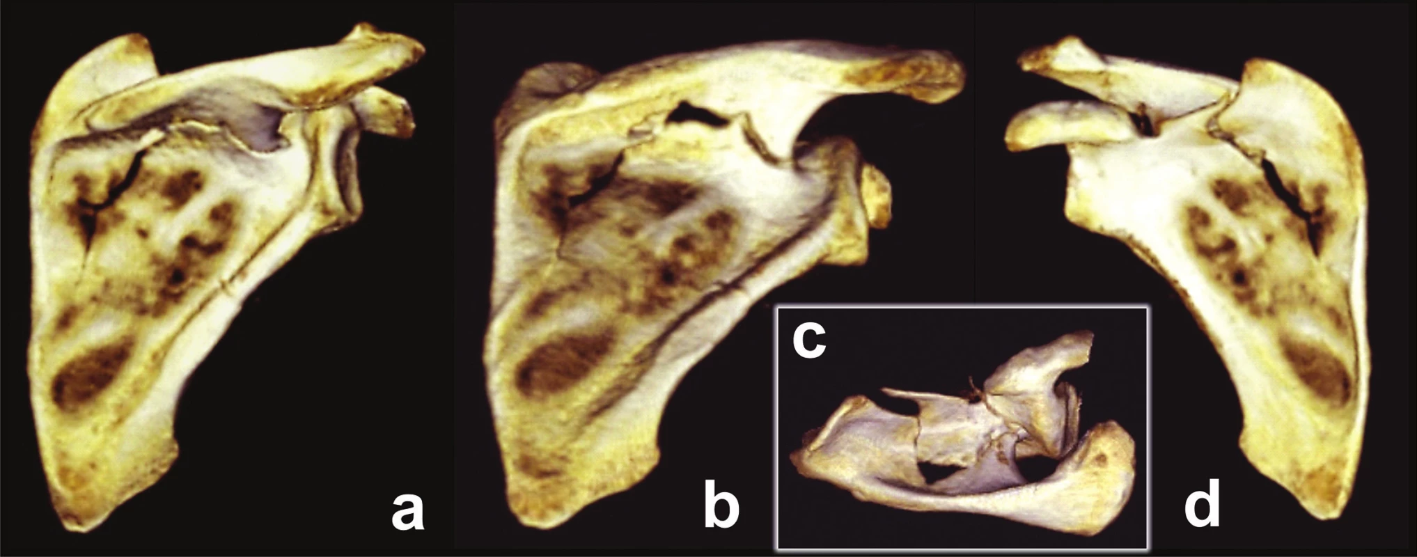 Spinal pillar fracture – scapular spine broken off the scapular body.
a – posterior view; b – posteroinferior view; c – superior view; d – anterior view.