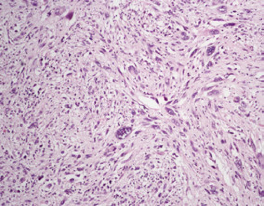High grade sarkom, hematoxilin-eozin
Fig. 4. High-grade sarcoma, haematoxylin-eosin