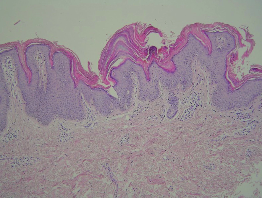 Histologie – případ 3: granulární parakeratóza (HE, zvětšení 100krát).