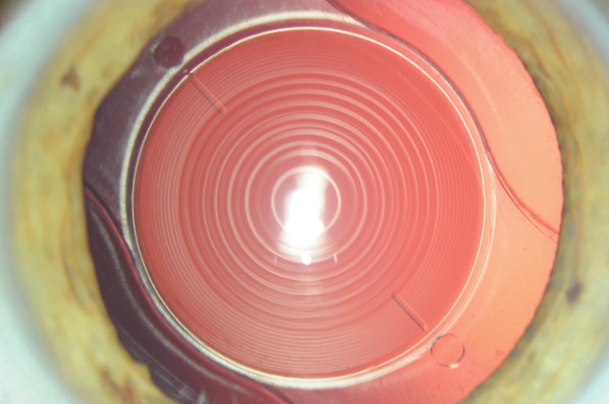 Trifokální torická čočka AT LISA tri toric 939MP (Carl Zeiss Meditec AG)