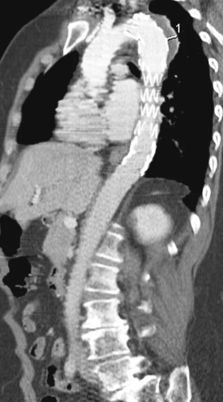 Kontrolní CTA půl roku po zavedení hrudního stentgraftu bez komplikací
Pic. 8. A control CTA six months after introduction of the thoracic stentgraft, with no complications