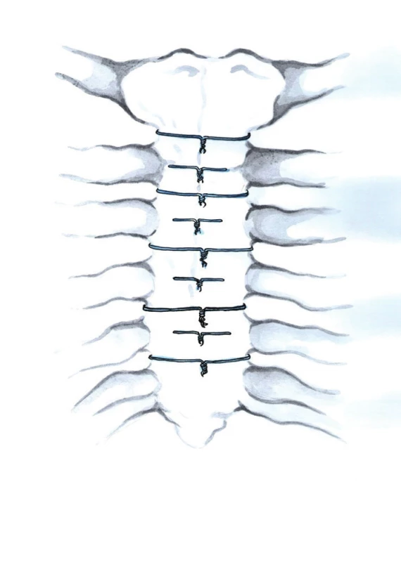Střídání jednotlivých transsternálních a peristernálních drátů (Kresba archiv autora)
Fig. 4: Alternating single peristernal and transsternal wire closure