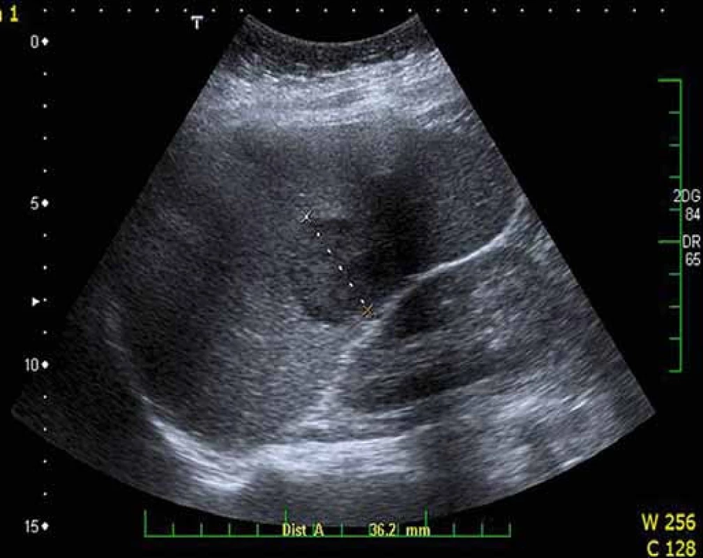 Ložisko lymfomu ve slezině. Ultrazvukové vyšetření sleziny prokazující hypoechogenní ložisko v hilu velikosti 31 mm.
Fig. 6. Lymphoma mass in the spleen. Spleen ultrasound showing hypoechogenic mass in the spleen, 31 mm in diameter.