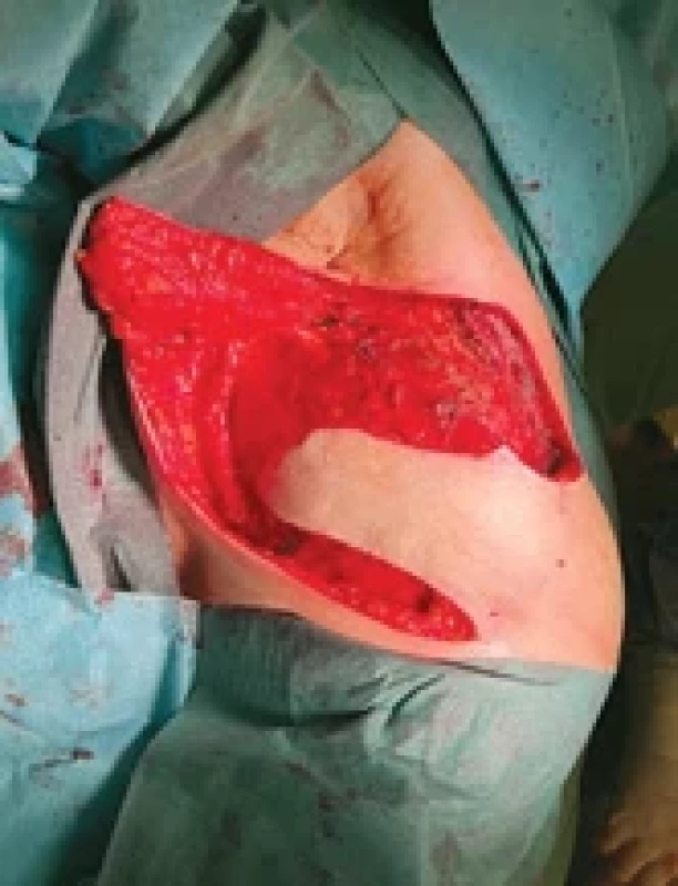 Řešení defektu transpozicí fasciokutánním lalokem. Fig. 4. Reconstruction of the defect using a fasciocutaneous transposition fl ap.