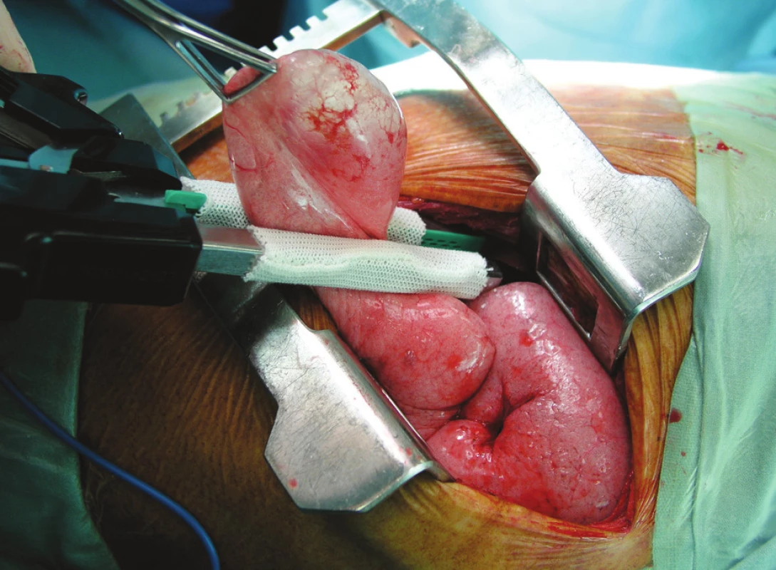 Resekce plicní buly pomocí stapleru s návlekem
Fig. 2. Resection of pulmonary bullae by stapler with slip‘s