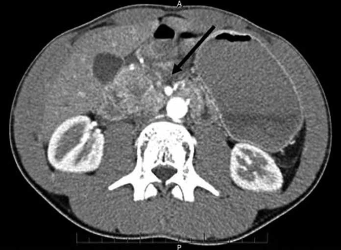 CT břicha – lacerace v oblasti hlavy pankreatu (šipka).
Fig. 1. Abdominal CT scan – laceration of the pancreatic head (arrow).