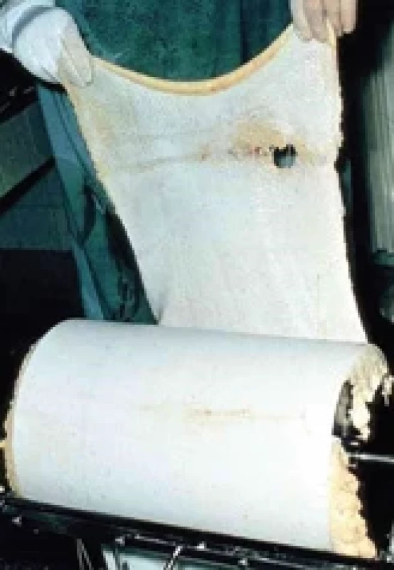 Harvesting 3 blocks of skin grafts.
