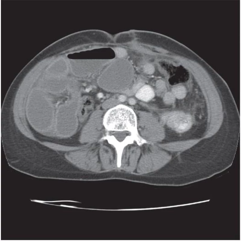 CT: Distendované střevní struktury, ileózní stav
Fig. 3 CT: Distended bowel, status ileosus