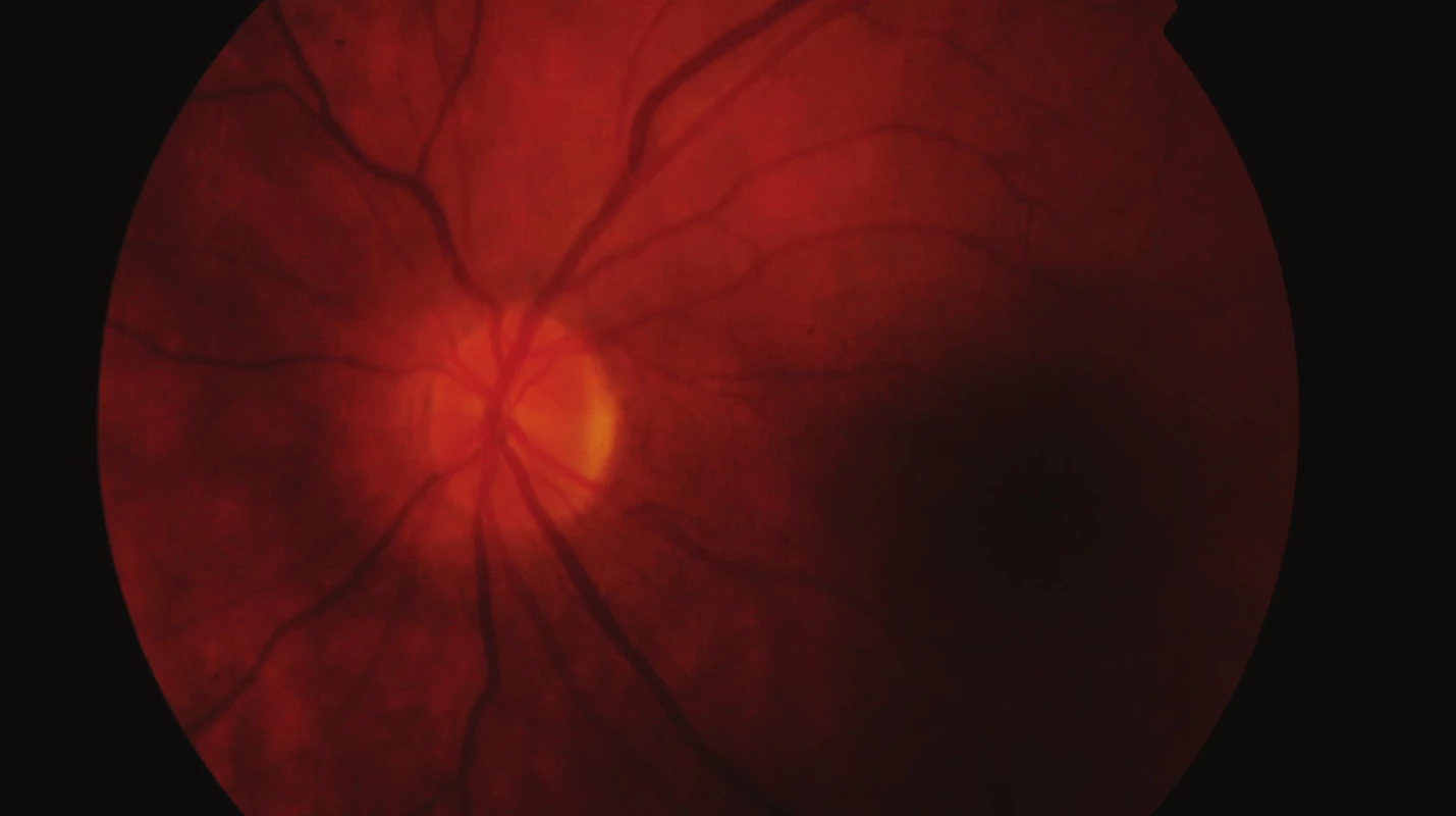 Fundus levého oka 5 měsíců po vzniku pretrombotického stavu