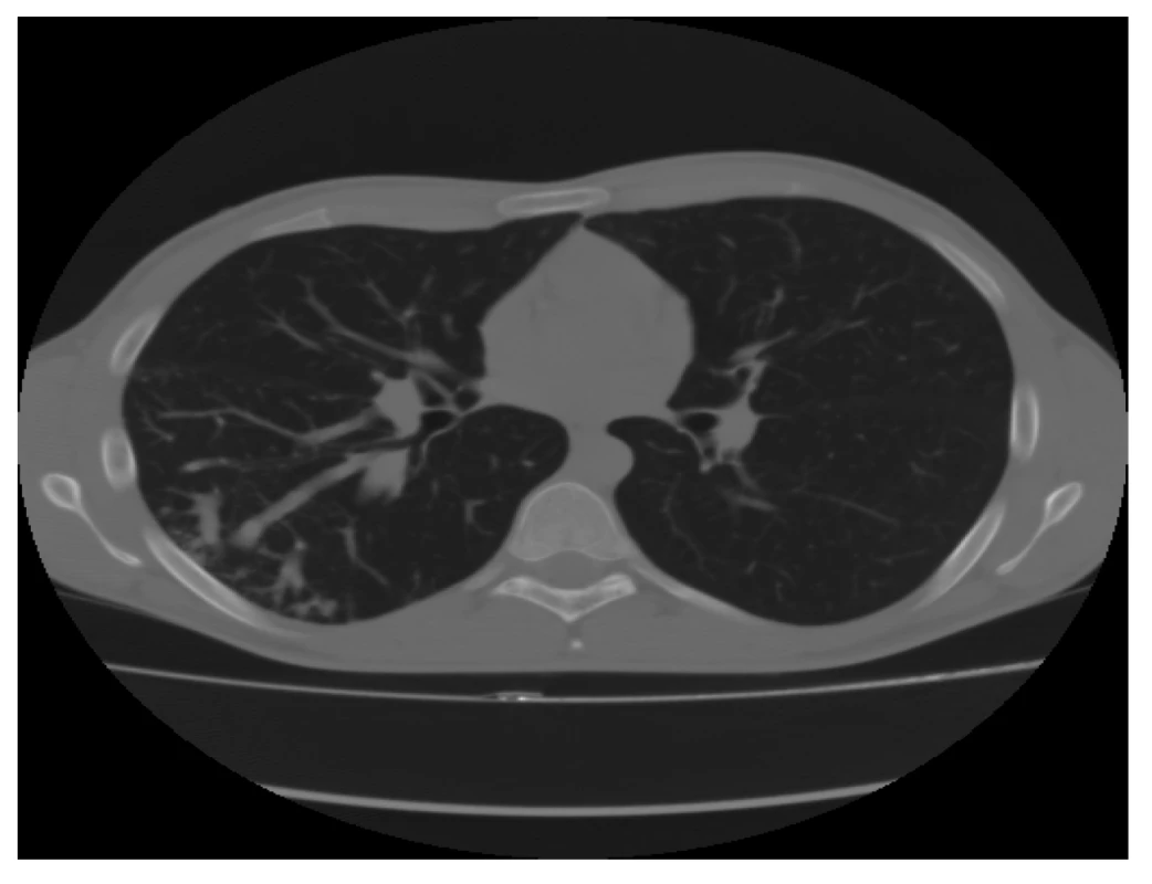 CT plic − transverzální řez v plicním okně: prokazuje
atypické, rozšířené, mnohočetné cévní struktury
pravého dolního laloku<br>
Fig. 1: CT scan of the lungs, transverse cut in the pulmonary
window: atypical, enlarged, multiple vascular
structures of the lower right lobe