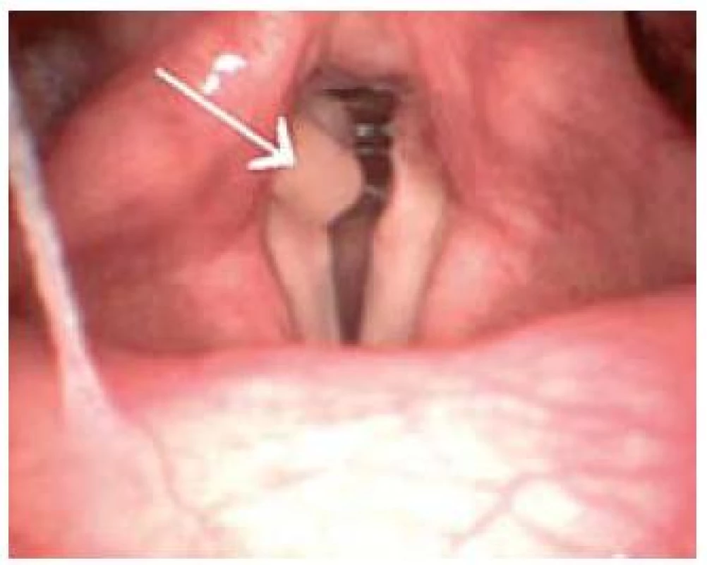 Granulom pravé hlasivky (označený šipkou) způsobený extraezofageálním refluxem.
Fig. 1. Granuloma of the right vocal chord (arrow) caused by extraesophageal reflux.