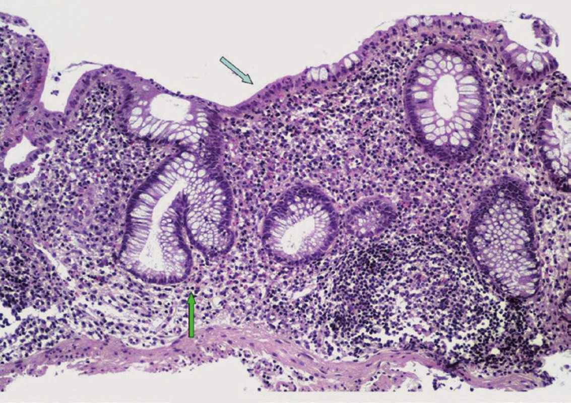 Histologický obraz PSC-IBD. Narušená slizniční architektonika s větvením a zkrácením Lieberkühnových krypt (bílá šipka), s nečetnými neutrofilními leukocyty mezi epiteliemi povrchové výstelky (černá šipka), chronický zánětlivý infiltrát v lamina propria mucosae (hematoxylin-eozin, původní zvětšení ×100).
Fig. 2. Histopathological features of PSC-IBD. Mild chronic active colitis characterized by architectural distortion of the intestinal mucosa with branched and shortened crypts (white arrow); neutrophils are focally present within the lamina propria and surface epithelium (black arrow); the lamina propria is expanded by chronic inflammatory infiltrate (hematoxylin-eosin, original magnification ×100).
