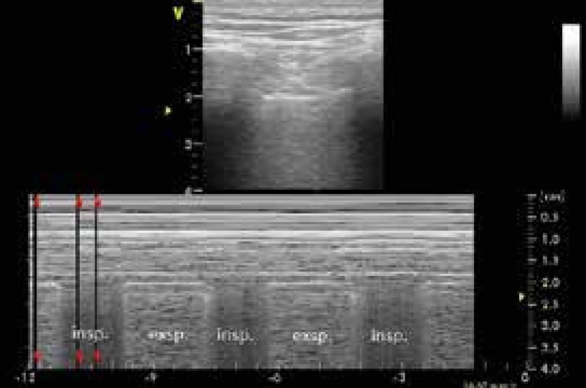 Pneumotorax: lung point detekovaný lineární
sondou v přední axilární čáře. M-mode je
normální (sea-shore sign) v inspiriu, během
nějž se pod sondu nasouvá viscerální pleura.
V exspiriu je zde pneumotorax (bar-code sign)